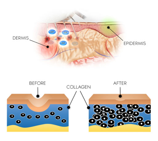 Collagen Induction Therapy Collagen Induction Therapy